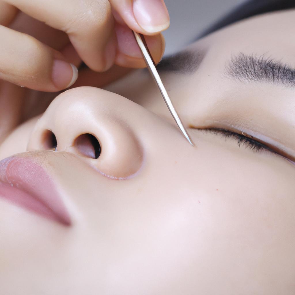 美容鍼で見た目もリフレッシュ